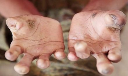 Menolak Lupa: Kusta Di Papua Barat Butuh Perhatian Serius