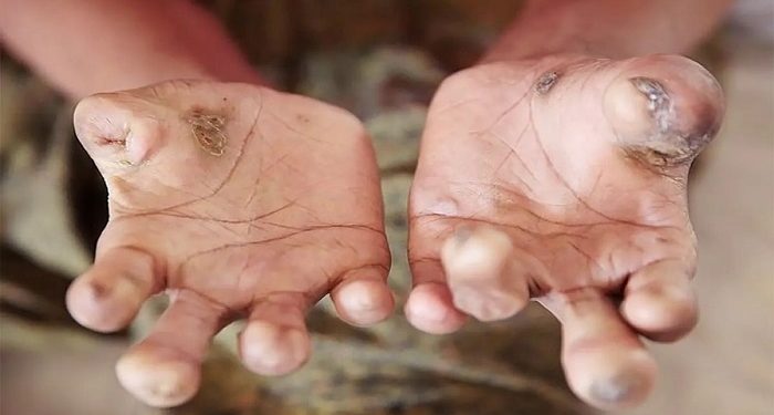 Menolak Lupa: Kusta Di Papua Barat Butuh Perhatian Serius
