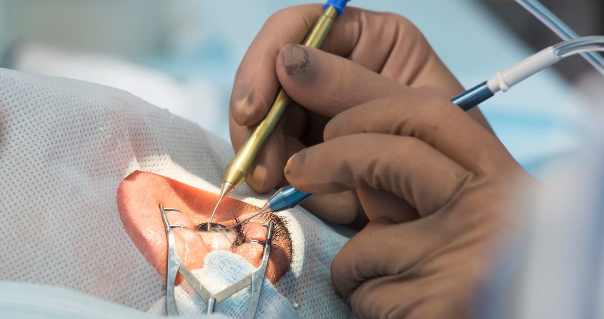 Biar Gak Nyesel: Cek Kekurangan Lasik Mata Ini